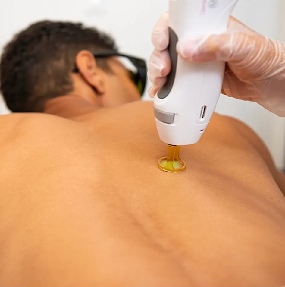 Back and chest laser hair removal