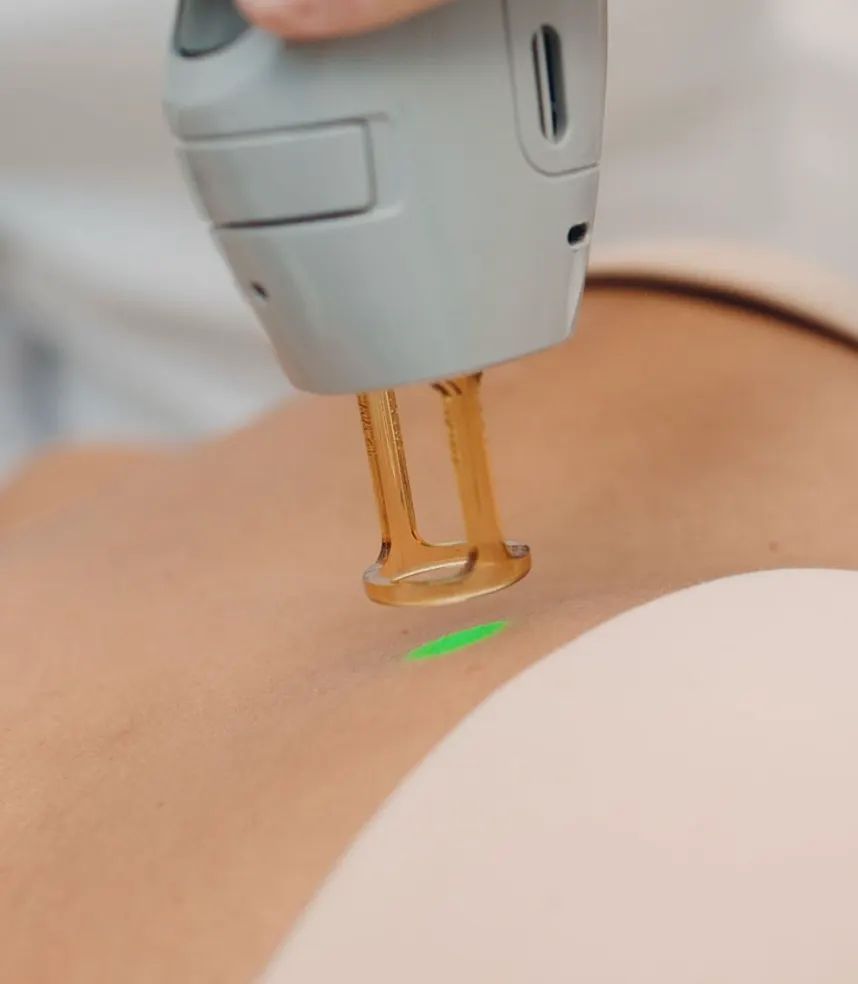 Bikini area laser hair removal