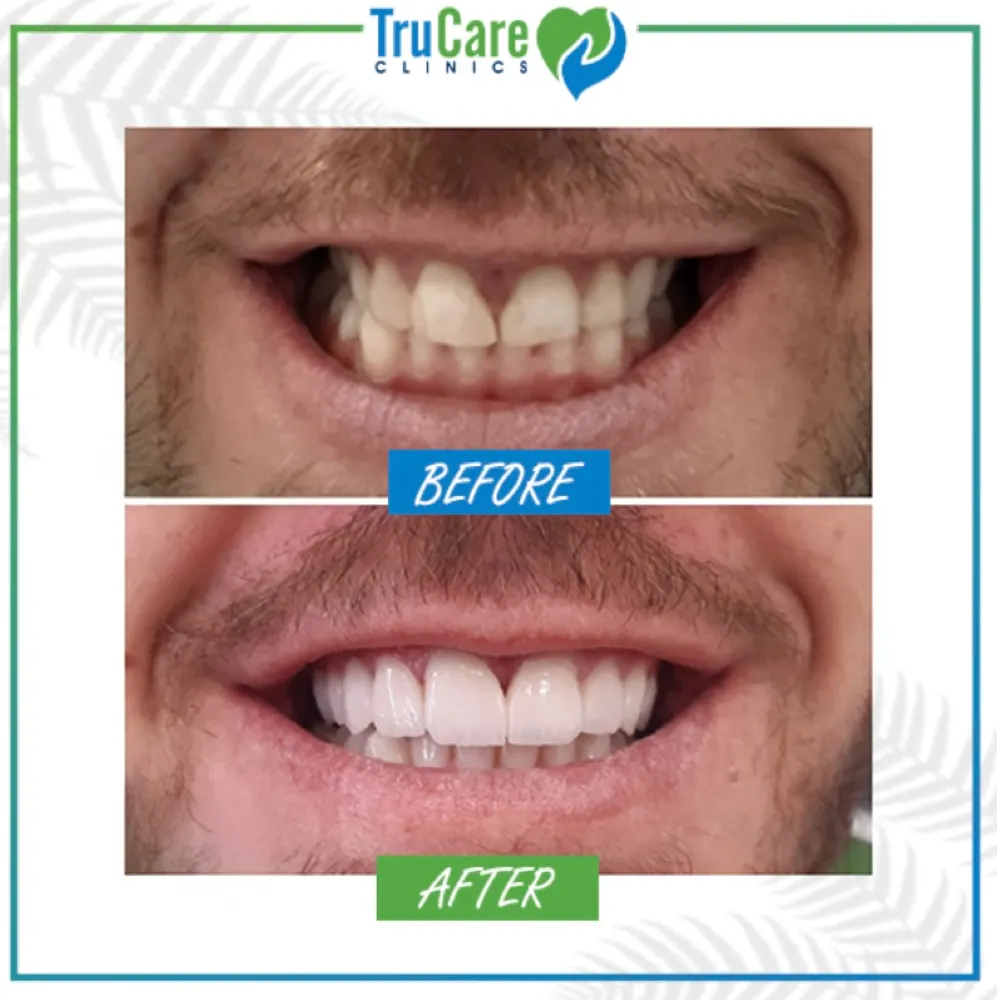 Veneers before and after at TruCare Clinics