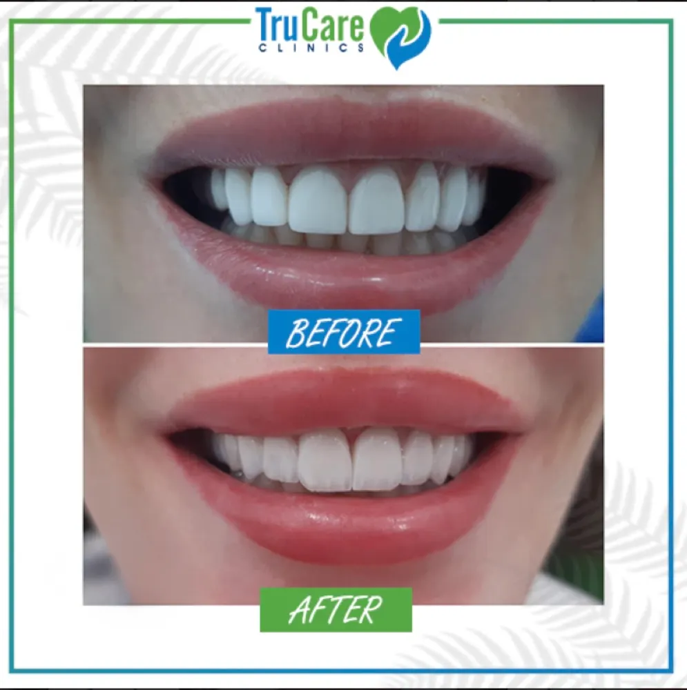 Veneers before and after at TruCare Clinics