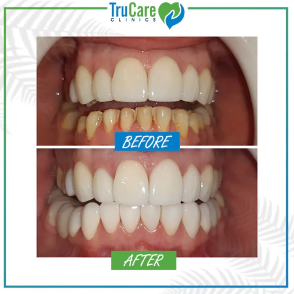 Veneers before and after at TruCare Clinics